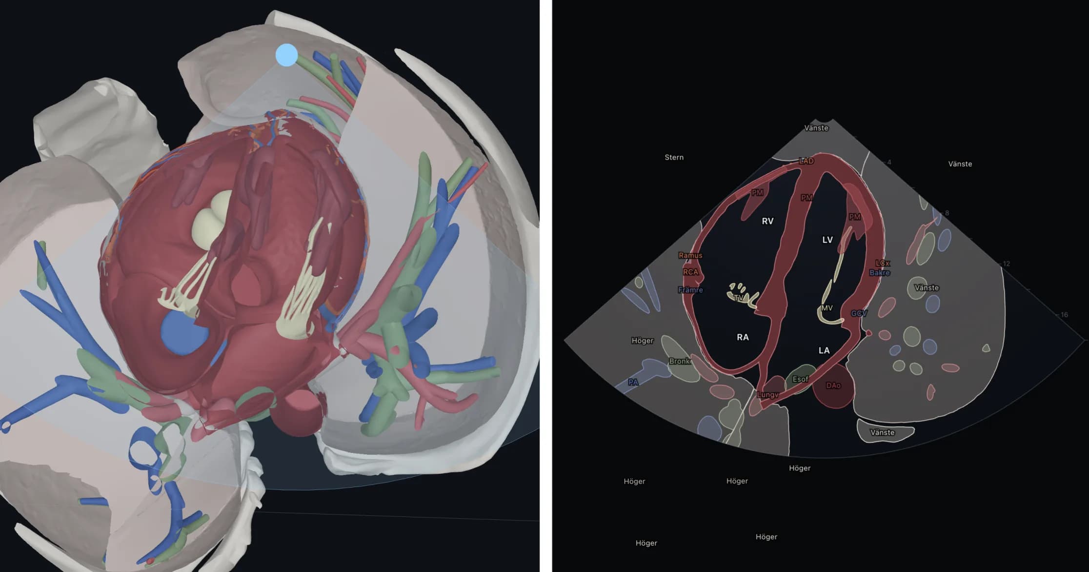 Hjärtat i 3D genomskuret i apikal fyrkammarvy, bredvid samma snitt ritat som en ultraljudsbild