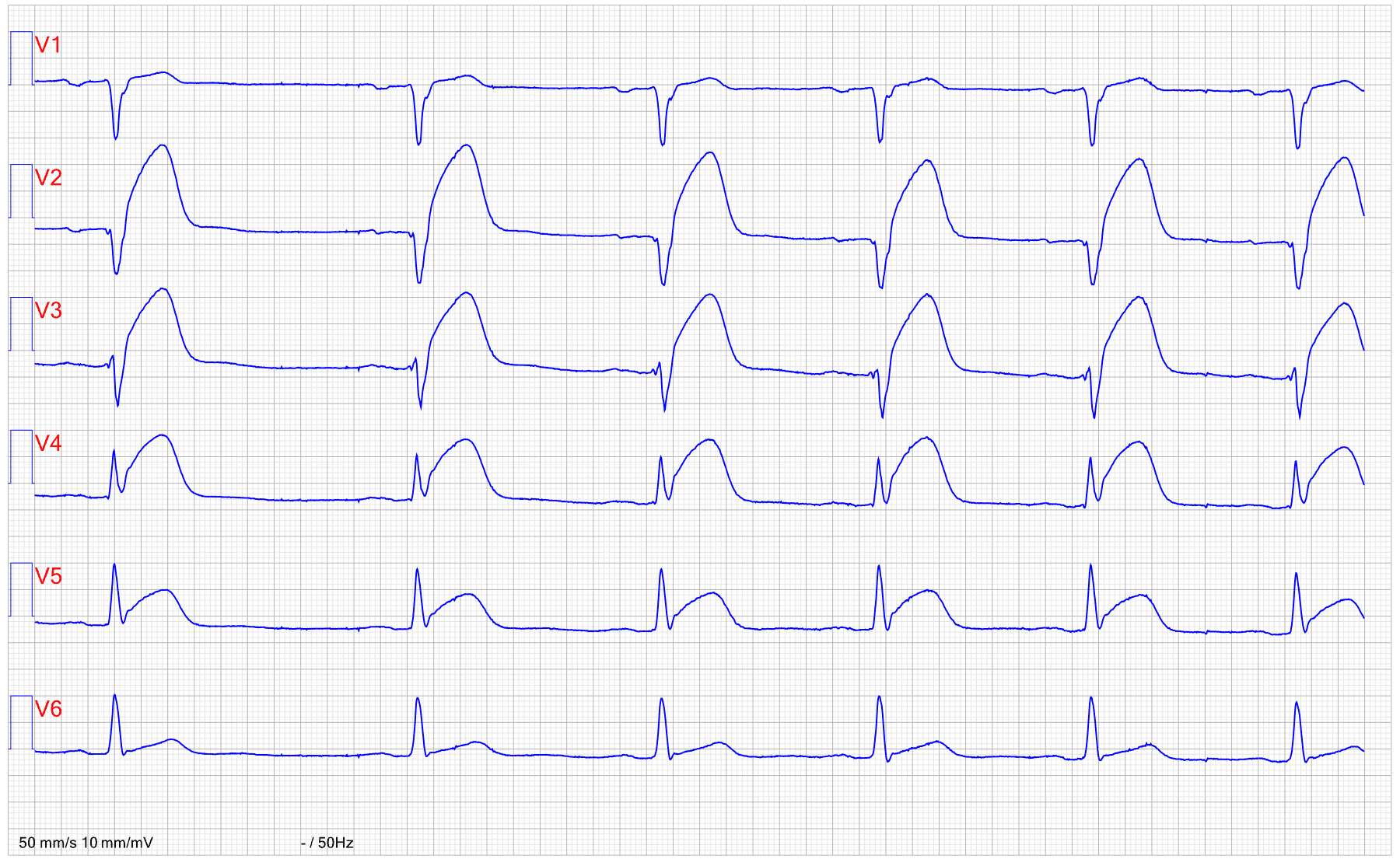 Illustration ur kursen EKG-boken