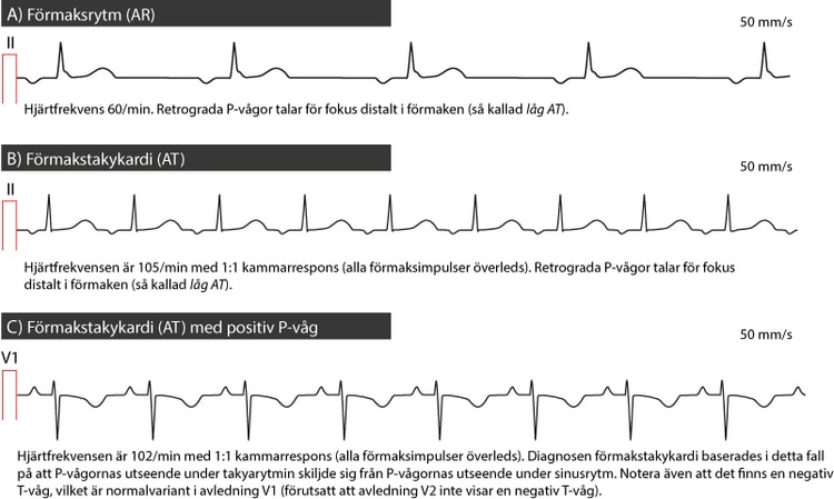 Figur 45. Förmakstakykardi och förmaksrytm.