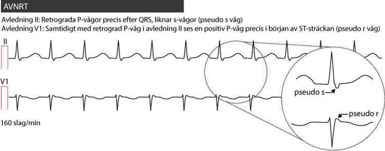 Figur 48.  AVNRT hos en 20-årig man. Besvärades av hjärtklappning och obehagskänsla i bröstet. Arytmin avbröts efter injektion 5 mg adenosin intravenöst.