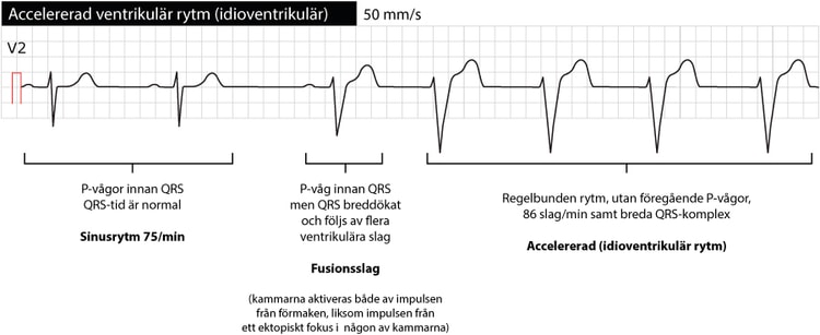 Sinusrytm som följs av ett fusionsslag och sedermera övergår i accelererad (idioventrikulär) rytm.
