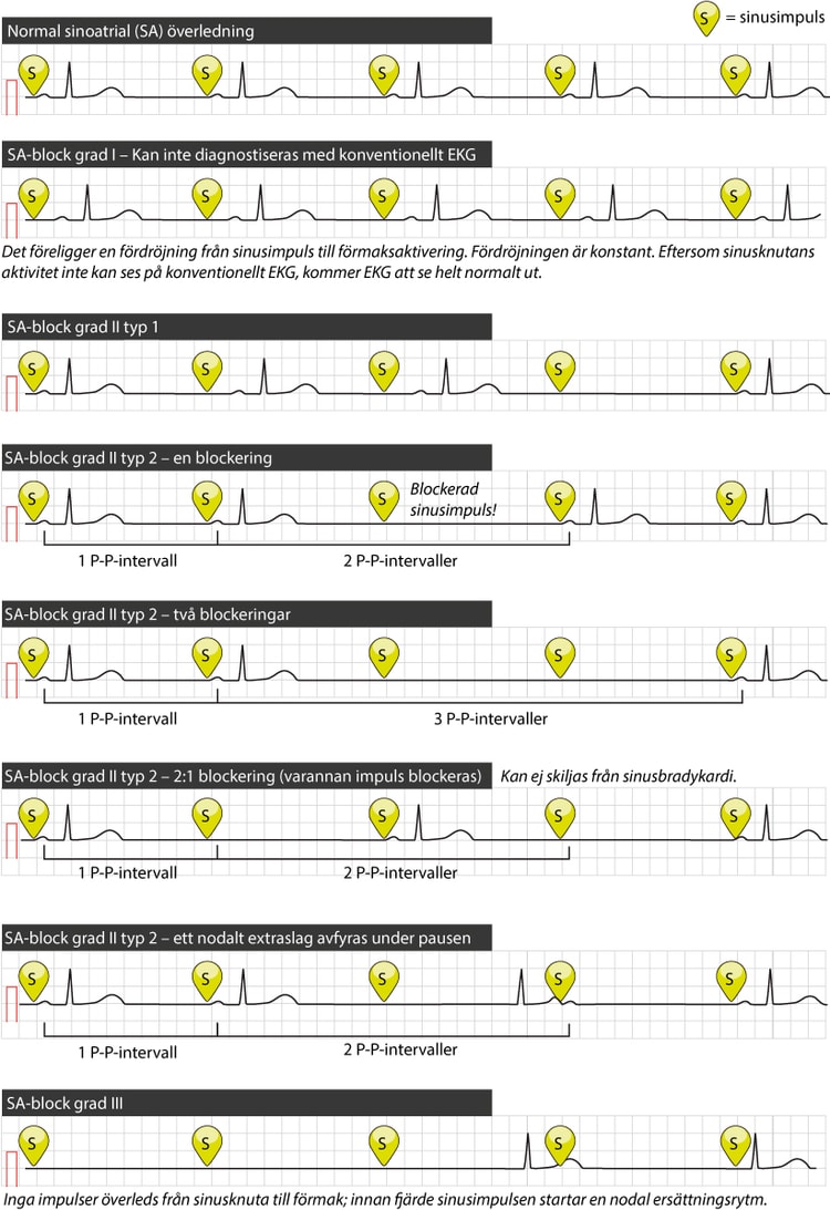 Figur 41. SA-block grad I till III. Delvis efter B Surawicz & Timothy Knilans; Chou’s electrocardiography in clinical practice (Elsevier 2008).