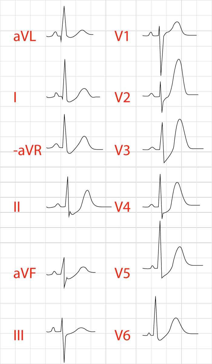 Patient med pågående bröstsmärtor vars EKG visar de Winters tecken. Notera uppåtsluttande ST-sänkningar och höga breda T-vågor (hyperakuta T-vågor).