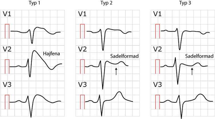 Figur 80. Brugada syndrom typ 1, typ 2 och typ 3.