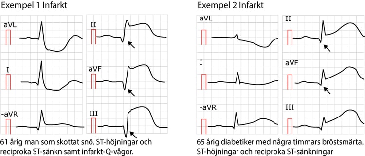 Exempel på ST-höjningsinfarkter (STEMI/STE-AKS). Notera att i båda dessa fall finns faktiskt patologiska Q-vågor (pilar), vilket antingen är gamla infarkter eller så har detta EKG registrerats flera timmar efter symptomdebuten.