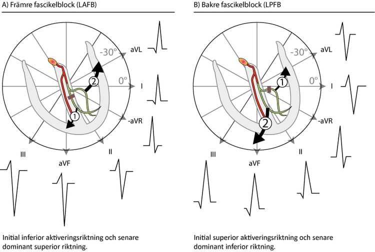 Figur 100. Främre och bakre fascikelblock. Delvis efter GS Wagner (Marriott's Practical Electrocardiography, Elsevier 2007) och AL Goldberg (Clinical Electrocardiography: A Simplified Approach, Elsevier Mosby 2006).