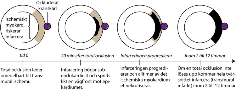 Figur 66. Förloppet från total ocklusion till transmural infarkt.