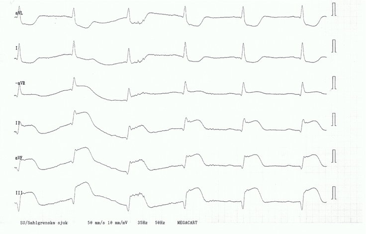 STEMI