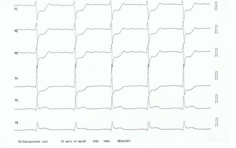 STEMI