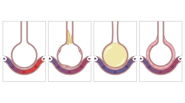Fyra schematiska alveoler med kapillärer: normal, slemhindrad luftväg, vätskefylld alveol och förtjockad alveolvägg, med blodets färg från blått till rött eller oförändrat.