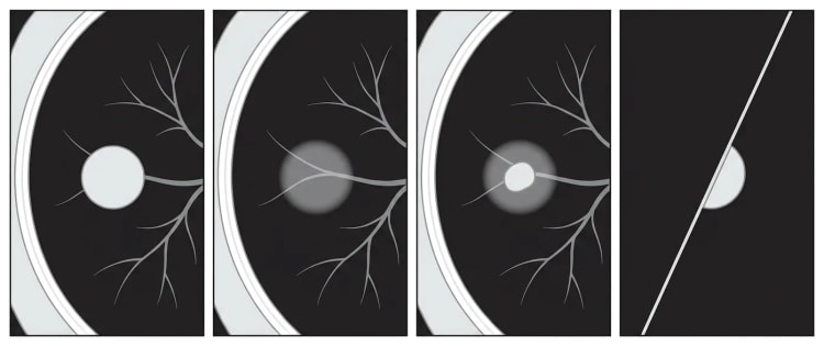 Fyra schematiska datortomografiutsnitt av lunga i lungfönster: solid nodul, ren ground glass-nodul, delsolid nodul och perifissural nodul.