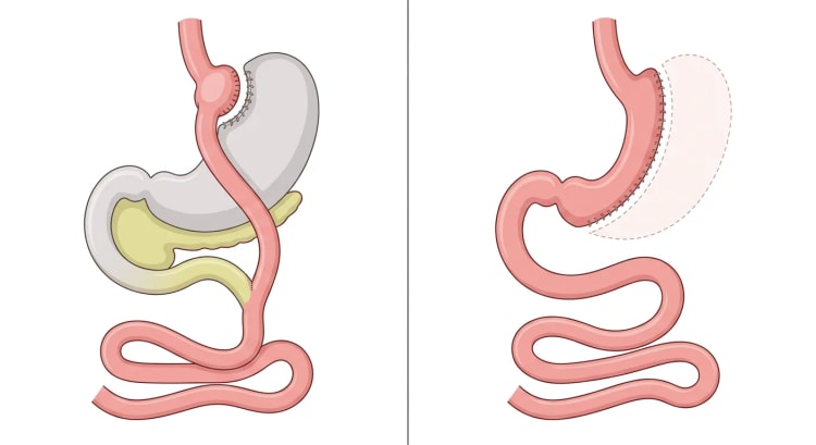 Två panelbilder av mag-tarmkanalen: till vänster anatomin efter Roux-en-Y gastrisk bypass, till höger efter sleeve gastrektomi.