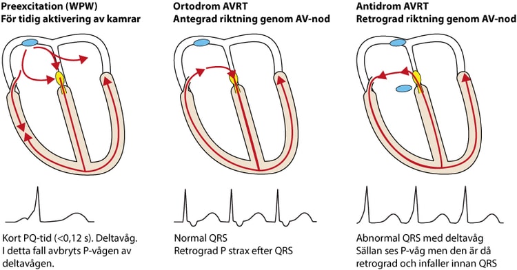 Figur 49. AVRT kräver en extrabana mellan förmak och kammare. Vid överledning från förmak till kammare under sinusrytm sker preexcitation (kamrarna aktiveras för tidigt) eftersom att fördröjningen i AV-noden förbigås.
