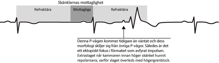 Figur 35. Aberrant överledning. Figuren visar hur ett supraventrikulärt extraslag anländer till kamrarna när höger skänkel är refraktär och slaget överleds med högergrenblocks-morfologi.