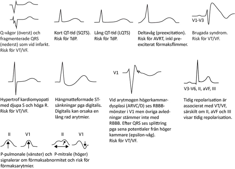 Figur 60. EKG-förändringar under sinusrytm som indikerar arytmipotential.