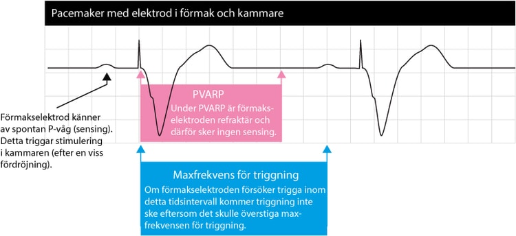 Pacemaker EKG