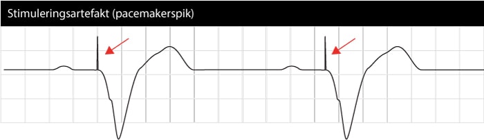 Pacemaker EKG