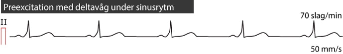 Figur 50. Preexcitation under sinusrytm med kort PQ-tid och tydliga delta-vågor.