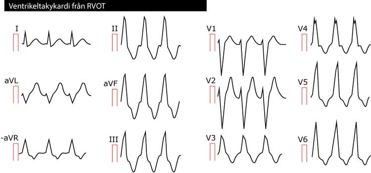 Figur 54. Ventrikeltakykardi från höger kammares utförselgång (RVOT). Som framgår i bröstavledningarna påminner QRS-komplexen om vänstergrenblock.