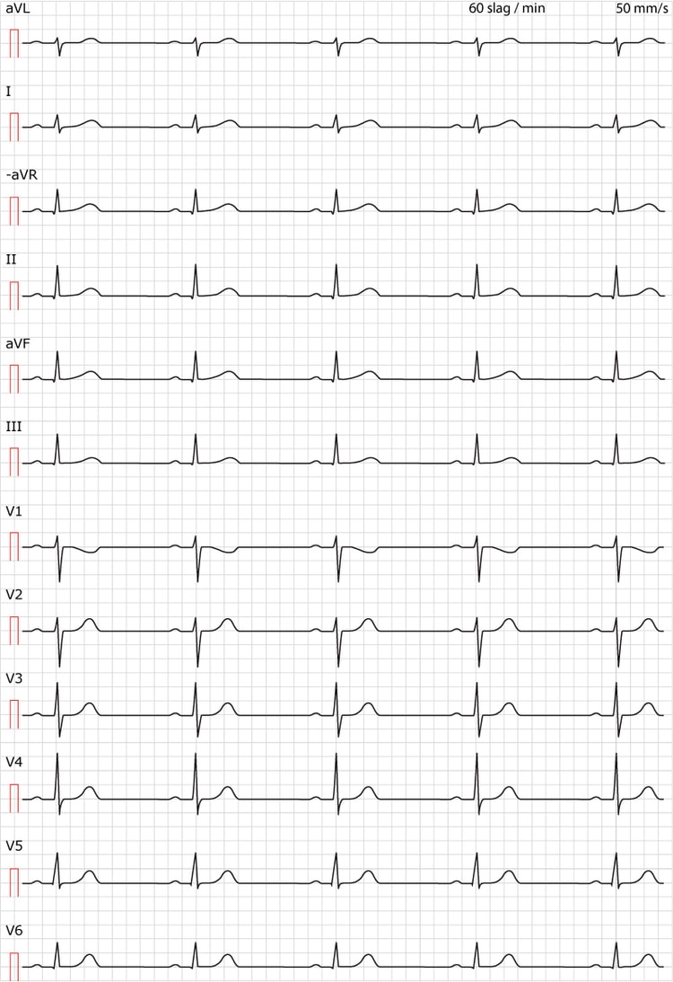 Figur 38. Sinusrytm. Normalt EKG i övrigt.