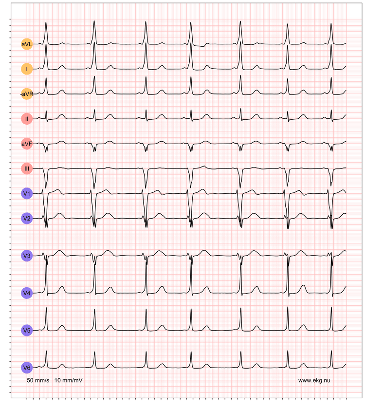 EKG exempel 2. Patient med pre-excitation på vilo-EKG.