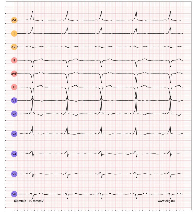 EKG exempel 3. Patient med pre-excitation på vilo-EKG.