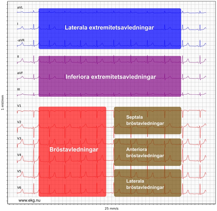 Figur 6. 12-avlednings-EKG enligt Cabrera.