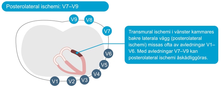 Figur 8. Posteriora bröstavledningar vid posterolateral ST-höjningsinfarkt. Dessa avledningar bör anbringas vid misstanke om posterolateral engagemang (reciproka ST-sänkningar i V1-V3).