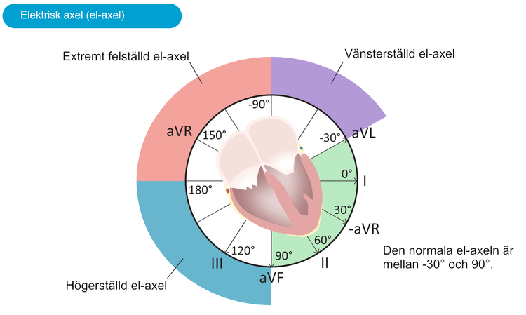 Figur 17. Hjärtat elektriska axel (el-axel) beräknas i extremitetsavledningarna. El-axeln representerar den genomsnittliga strömriktningen (under hjärtcykeln) i frontalplanet.