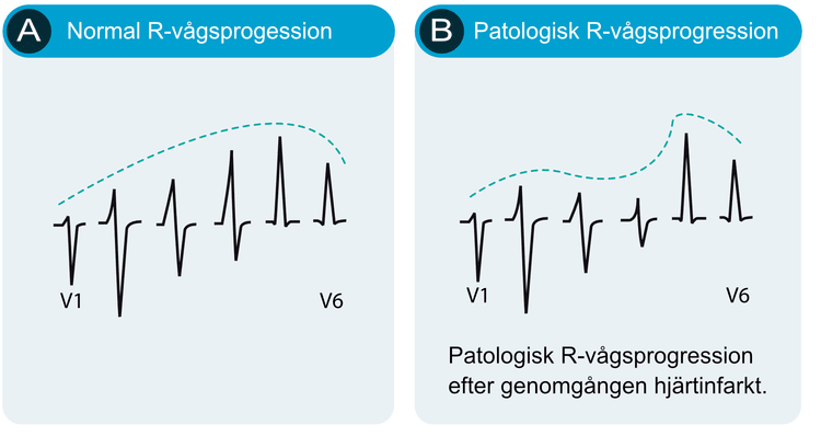 Figur 9. Normal (A) och patologisk (B) R-vågsprogression i V1-V6.