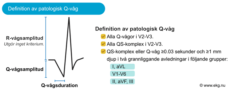 Figur 10. Definition av patologiska Q-vågor på EKG. Dessa EKG-förändringar talar starkt för genomgången hjärtinfarkt, förutsatt att patienten inte har ett vänstergrenblock eller vänsterkammarhypertrofi. Kriterierna är fastställda av ESC (Thygesen et al, Fourth Universal Definition of Myocardial Infarction).