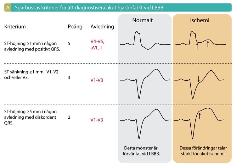 Figure 1A. Sgarbossas kriterier för akut hjärtinfarkt vid vänstergrenblock. Studier visar att ≥3 poäng ger en sensitivitet på 20-36% och specificitet på 90-98%