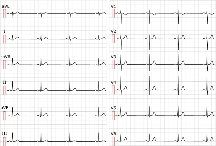 Figur 1. Sinusbradykardi. Notera att pappershastigheten är 25 mm/s. För att beräkna hjärtfrekvensen dividerar du 300 med antal stora rutor mellan kammarkomplexen. Det är cirka 6.5 stora rutor och 300/6.5 = 46 hjärtslag/minut. I övrigt är EKG normalt; viktigt är att P-vågen i avledning II är positiv.