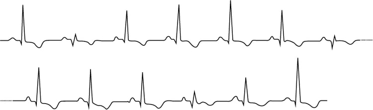 Figur 109. Elektrisk alternans vid hjärttamponad med 4 cm perikardvätska och hemodynamisk påverkan.