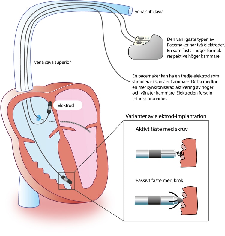 Pacemaker