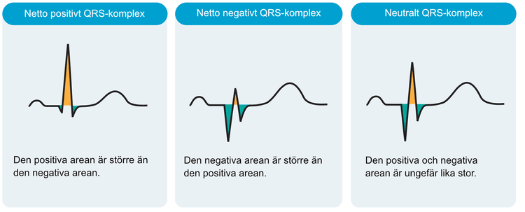 Figur 6. Positiva och negativa kammarkomplex. Notera i (A) att QRS och ST-T båda vetter uppåt, vilket är förväntat (normalt). I (B) är QRS negativt men ST-T-sträckan ändå positiv, vilket inte är förväntat.