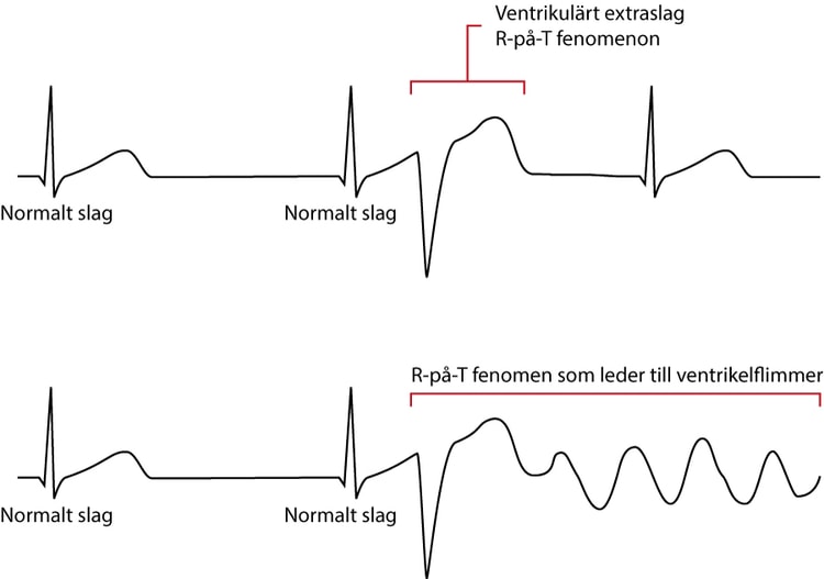 Figur 6 B. R-på-T fenomen