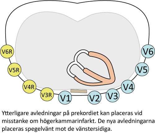 Figur 16. Högersidiga bröstavledningar vid högerkammarinfarkt. Dessa avledningar bör anbringas vid inferior infarkt för att utröna om även höger kammare drabbats.