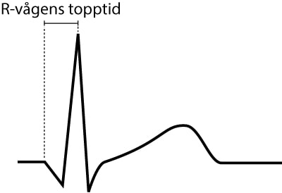 Figur 8. Tid från kammarkomplexets start till R-vågens topp är R-vågens topptid (eng R-wave peak time).