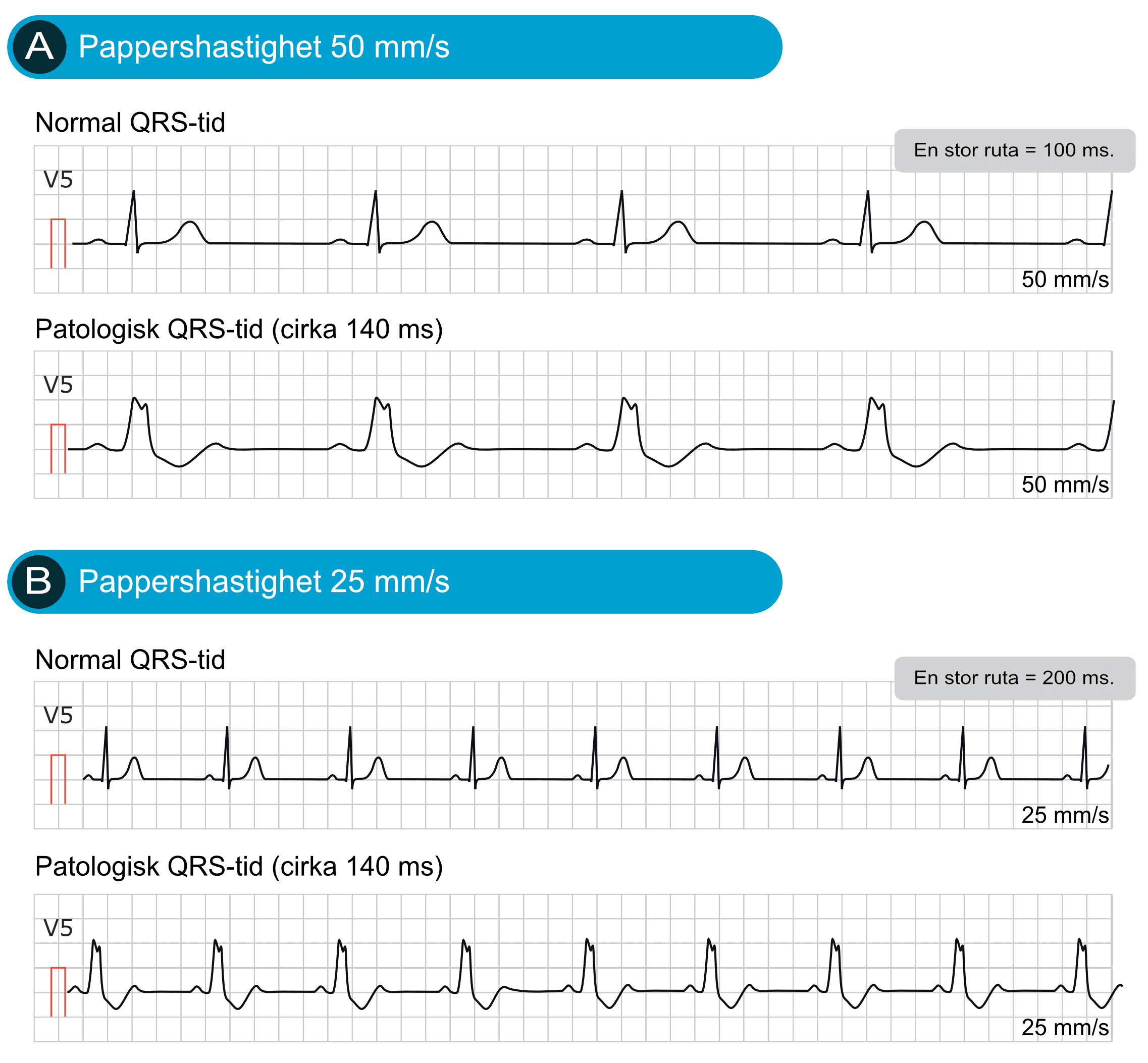Samma EKG-remsa registrerad i 50 mm/s och 25 mm/s, vilket ger olika bredd på komplexen trots identisk registrering.