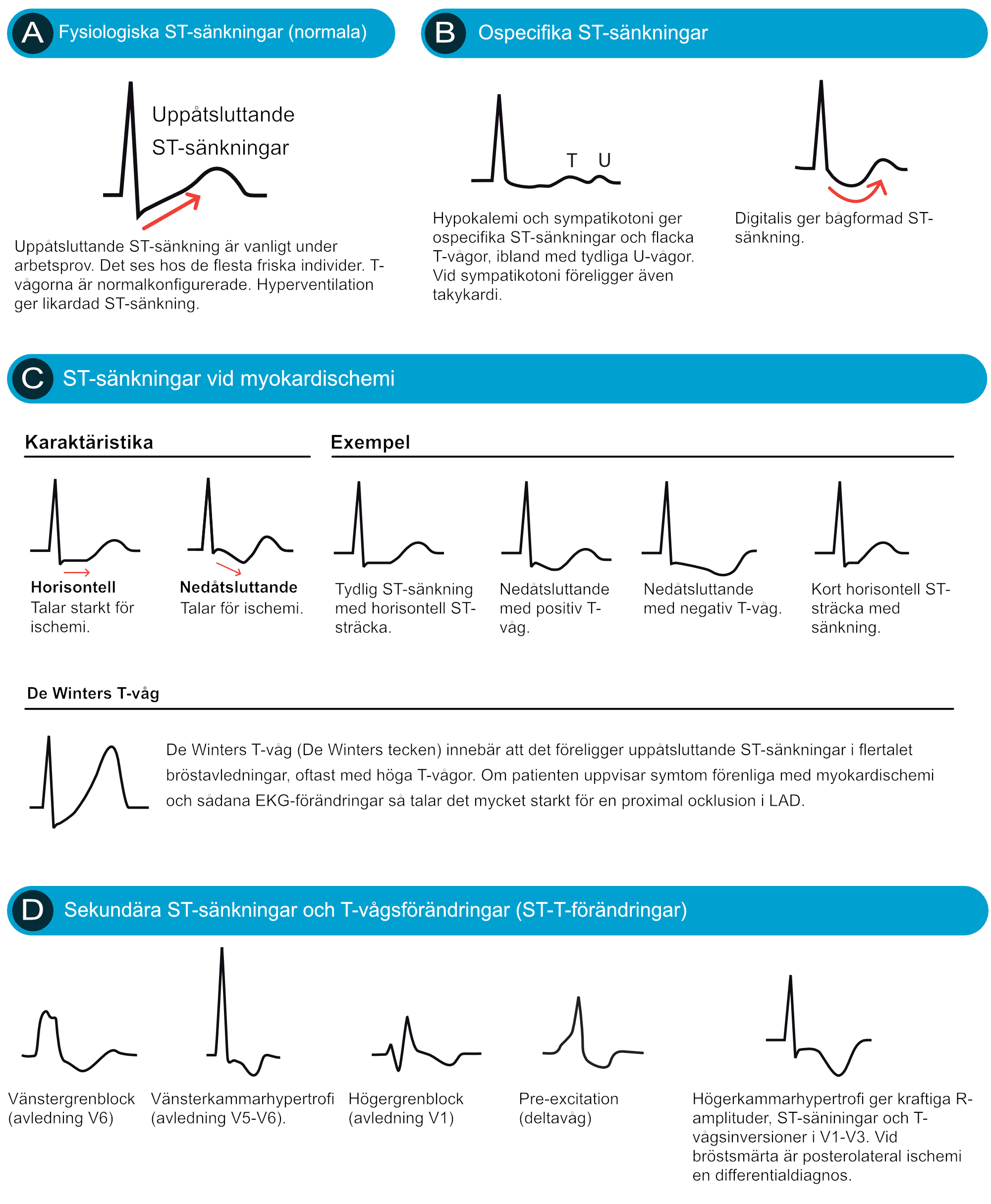 Atlas över ST-sänkningar med horisontella, nedåtsluttande och uppåtsluttande varianter.