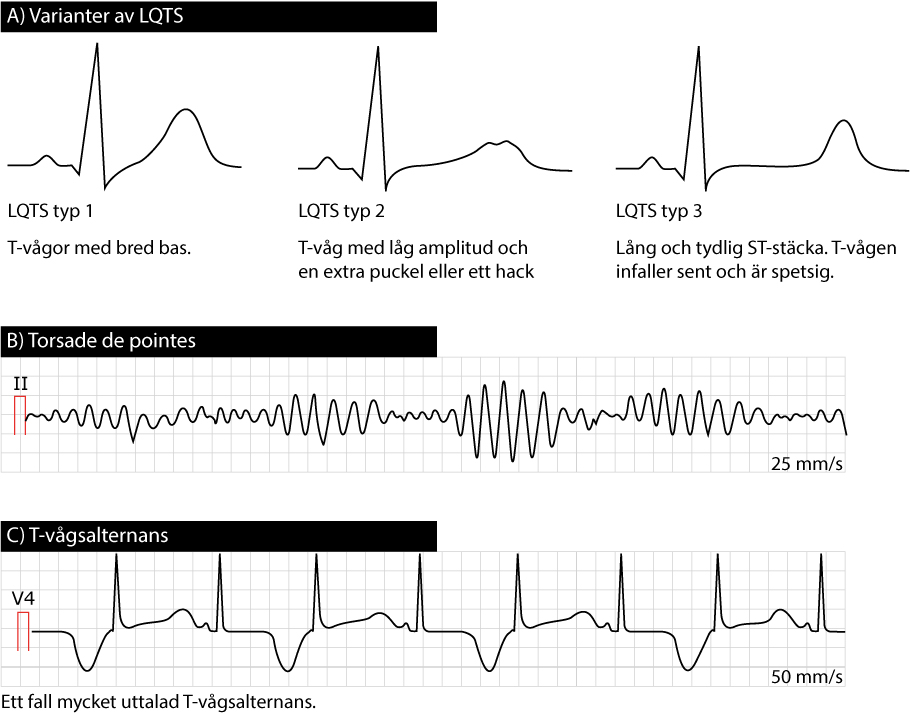 EKG med långt QT-intervall, torsades de pointes och T-vågsalternans.