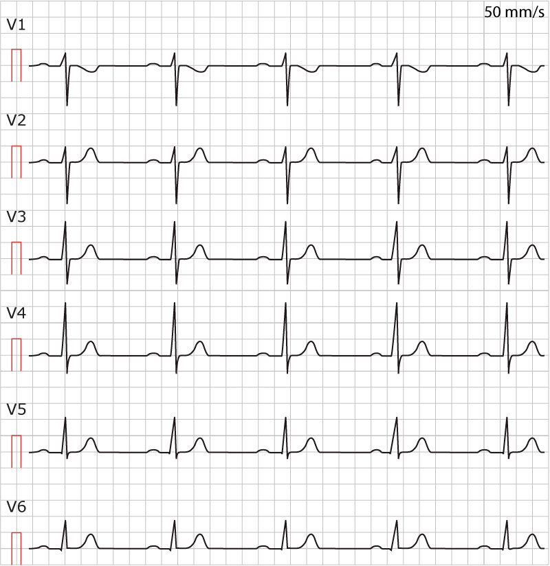 Figur 9. Kort QT-syndrom (SQTS). EKG från en 16-årig flicka vars mor avled i plötslig hjärtdöd. QT-tiden är ca 250 ms.