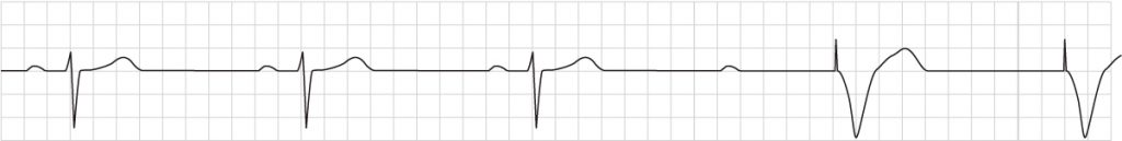 Rytmremsa där en pacemaker stimulerar kammaren efter en P-våg utan efterföljande QRS-komplex.