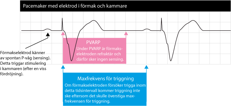 Pacemaker EKG