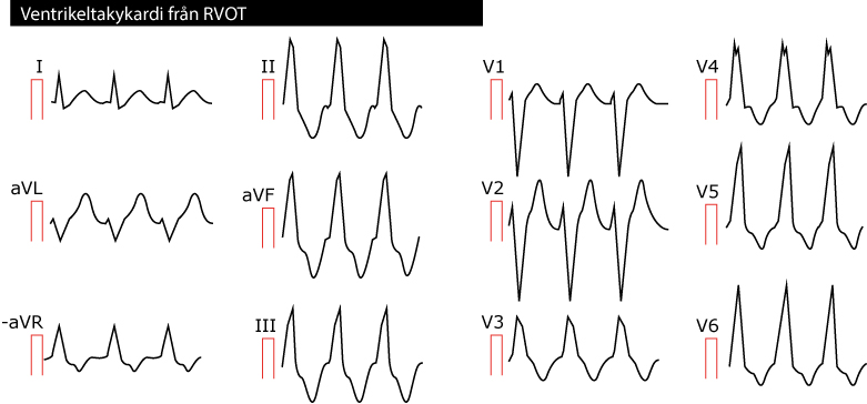 Figur 54. Ventrikeltakykardi från höger kammares utförselgång (RVOT). Som framgår i bröstavledningarna påminner QRS-komplexen om vänstergrenblock.