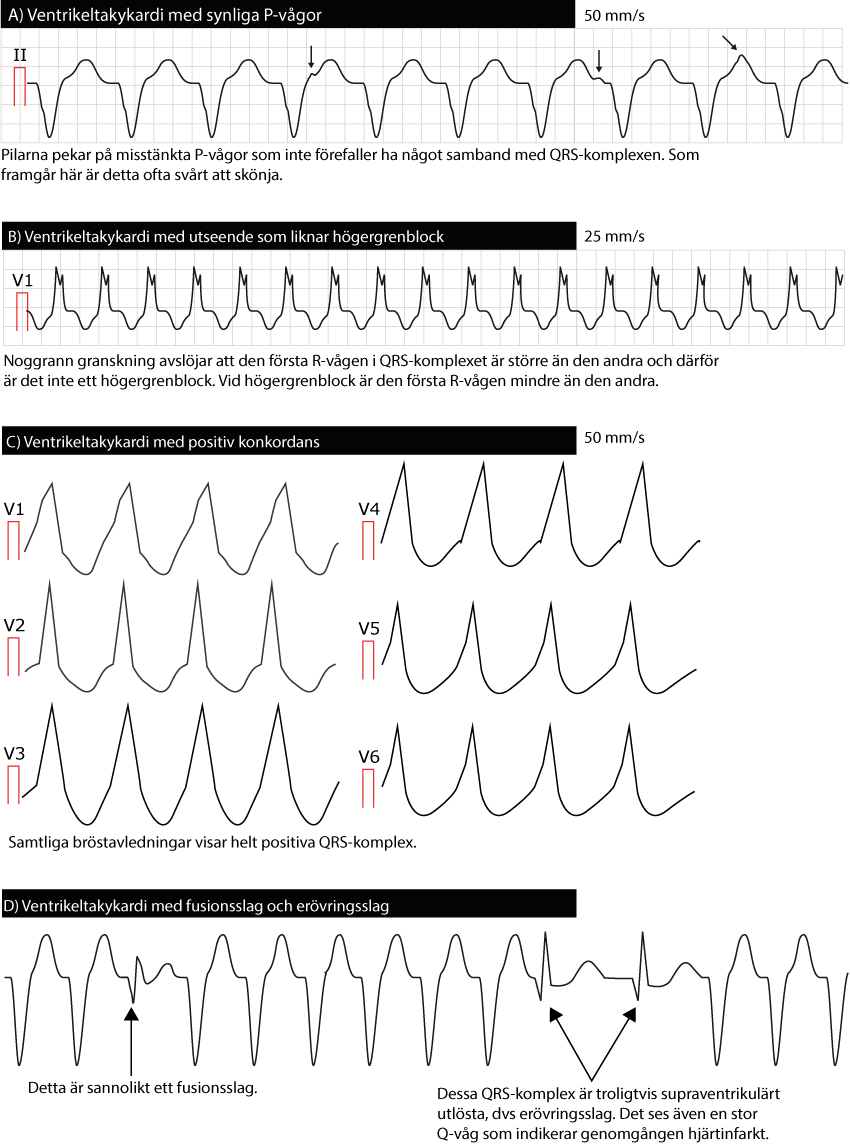 Flera varianter av ventrikeltakykardi på EKG.