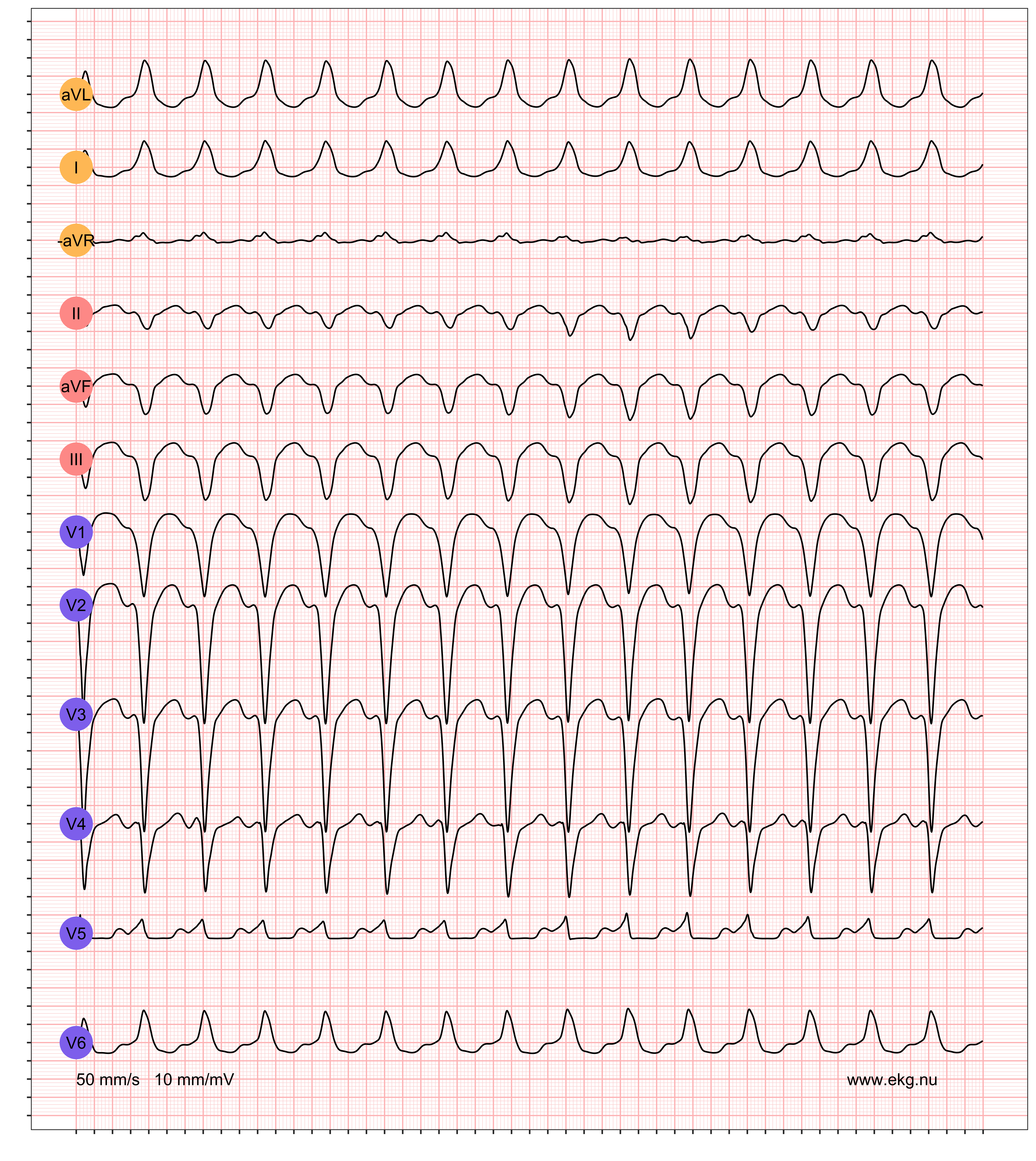EKG exempel 1. Patient med WPW-syndrom (pre-excitation med takyarytmier). Patienten har en känd WPW och detta EKG registreras under en pågående supraventrikulär takyarytmi.