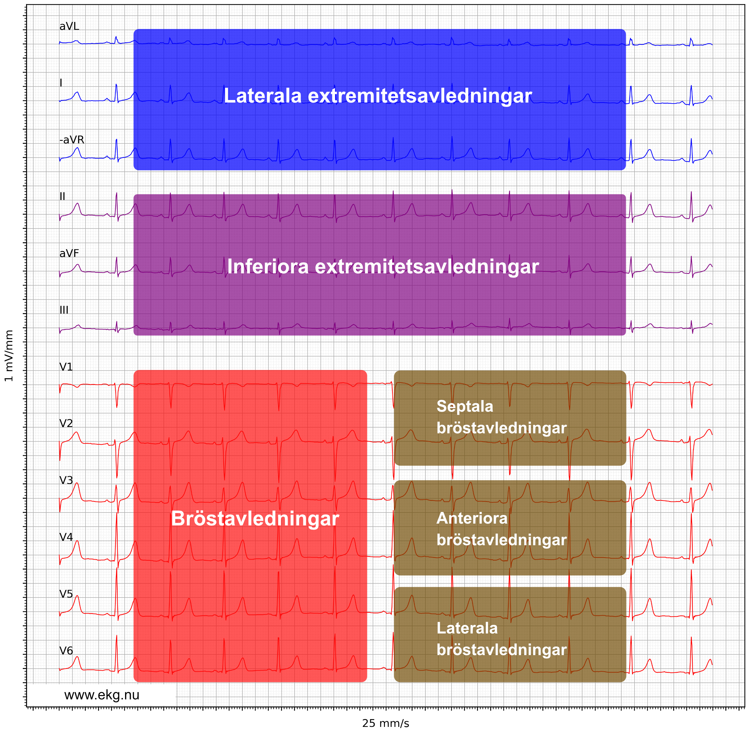 Figur 6. 12-avlednings-EKG enligt Cabrera.