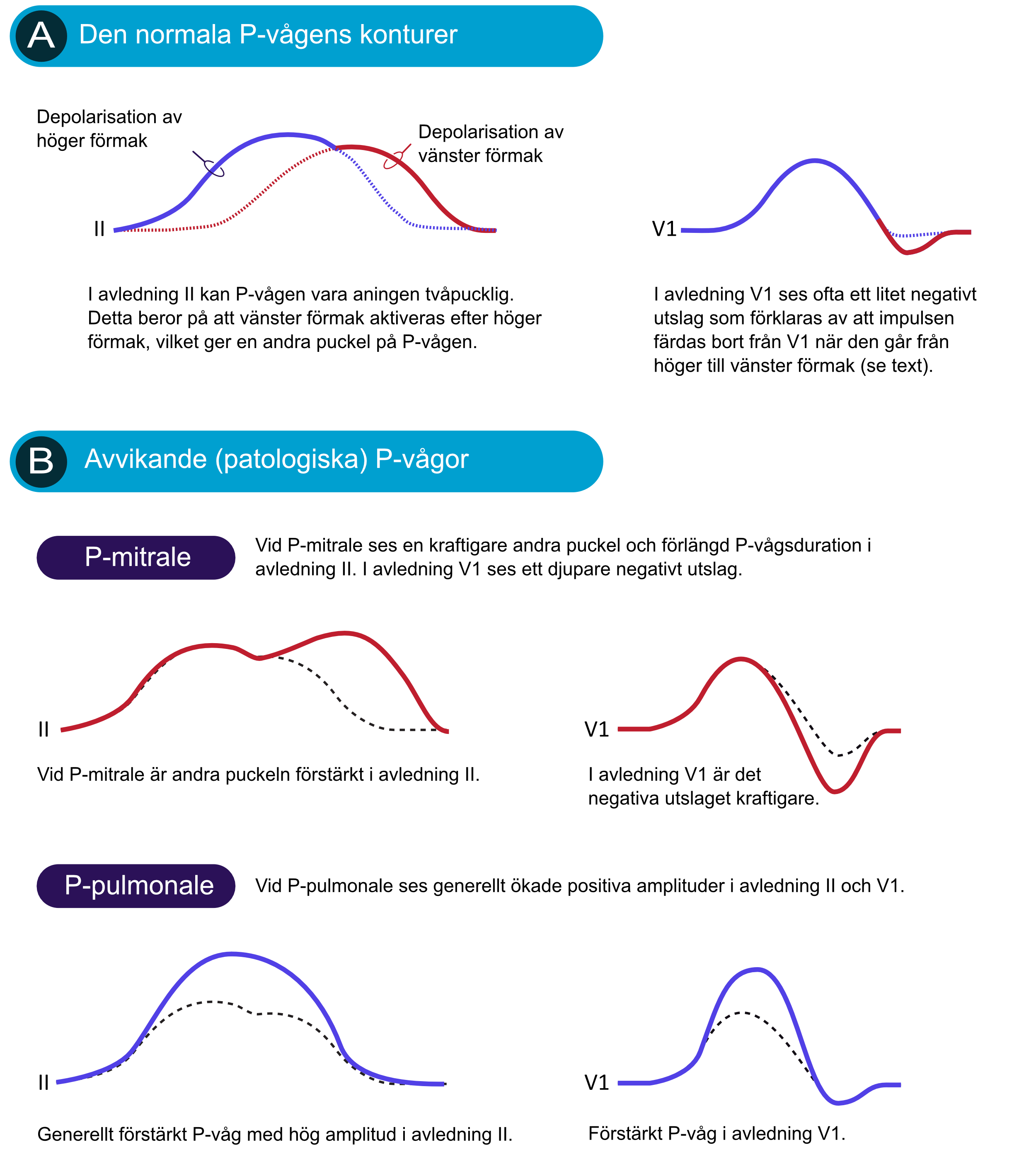 Schematisk jämförelse av normal P-våg, P-pulmonale och P-mitrale i avledning II och V1
